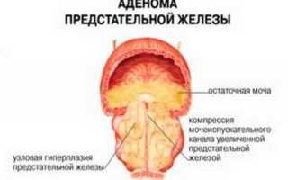 Послеоперационный период после удаления аденомы простаты