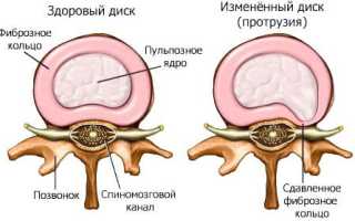 Протрузия дисков позвоночника что это такое