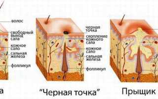Классификация прыщей и механизм их появления