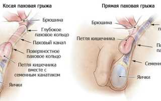 Как выглядит грыжа на яичке у мужчины и как лечиться