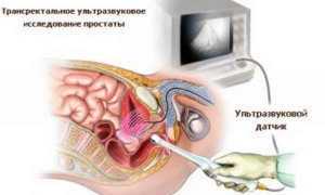 Конгестивный простатит