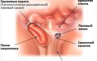 Паховая грыжа и методы ее лечения