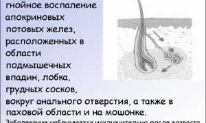 Комплексное лечение гидраденита