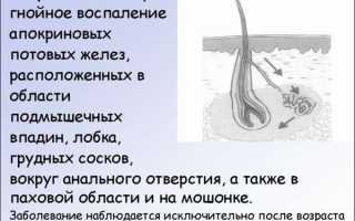 Комплексное лечение гидраденита