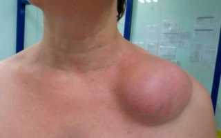 Опасна ли липома и как можно от нее избавиться