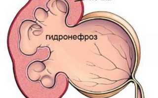 Симптомы и признаки гидронефроза почек