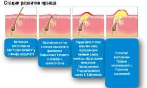 Лечение акне ретиноидами