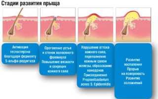 Лечение акне ретиноидами