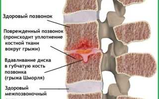 Что такое грыжа Шморля