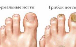 Почему увеличивается толщина ногтя и как вылечить недуг