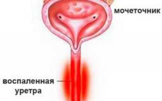Уретрит у мужчин
