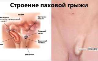 Возможно ли лечение грыжи в паху у мужчин без операции?