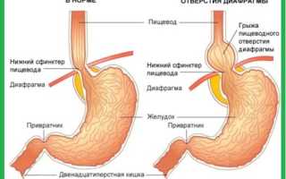 Какая диета при грыже пищевода