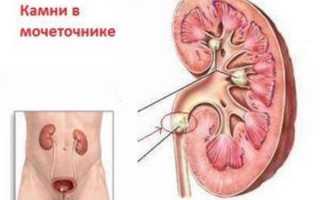 Стриктура уретры