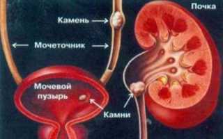 Профилактика мочекаменной болезни