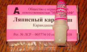 Эффективен ли ляписный карандаш от бородавок