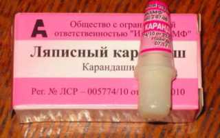 Эффективен ли ляписный карандаш от бородавок