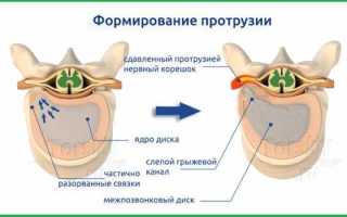 Диффузная протрузия дисков позвоночника что это такое