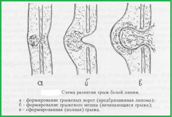 Схема развитий грыж белой линии живота.