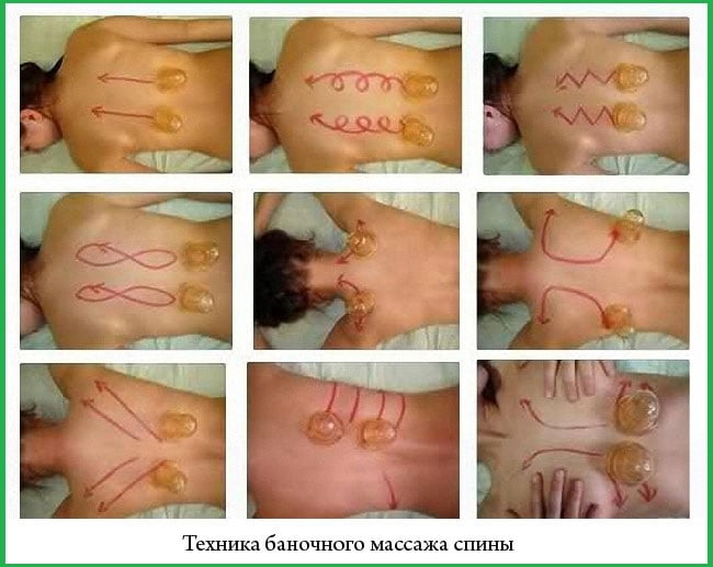 Женщине делают баночный массаж.