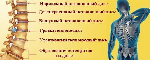 Мужчина держится за больную спину