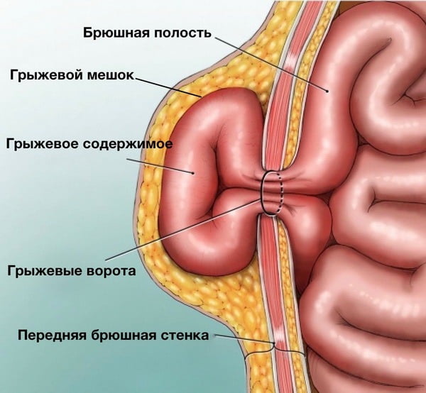 Рисунок с грыжей на передней стенке.