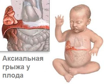 на рисунке плод с грыжей