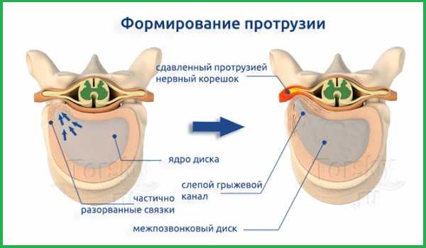 Рисунок о формирование протрузии.