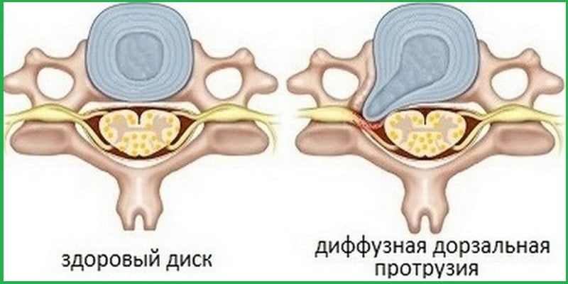 Рисунок о дорзальной протрузии.