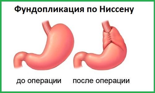 Фундопликация по Ниссену