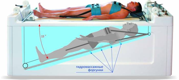 На рисунке пациентка лежит в гидромассажной камере.