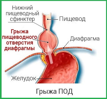 Так выглядит хиатильтная грыжа ПОД.