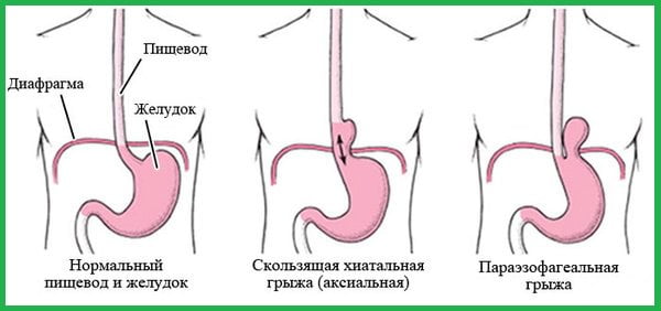 Различные виды хиатальной грыжи.