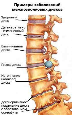 рисунок с грыжей