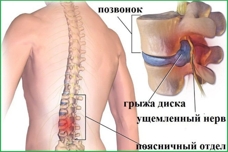Рисунок показывающий межпозвонковую грыжку