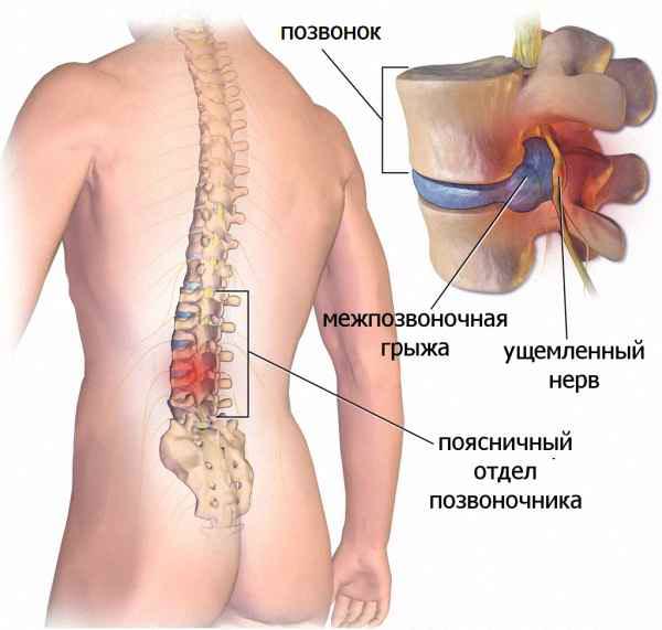 Схематичный рисунок грыжи на спине