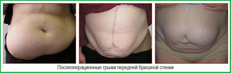 Послеоперационные грыжи, три фото.
