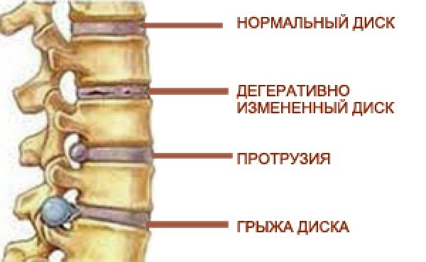 Схематичный рисунок про грыжу диска