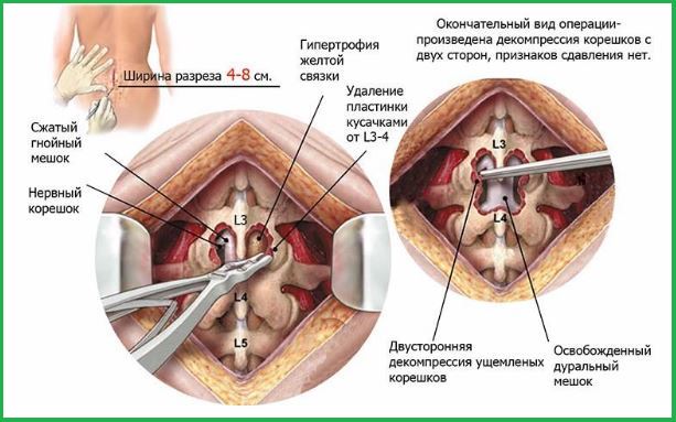 Рисунок показывает эндоскопическое удаление межпозвонковой грыжи.