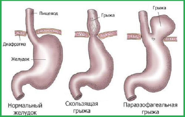 виды грыж