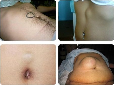 Фото пациентов с грыжей белой линии живота.