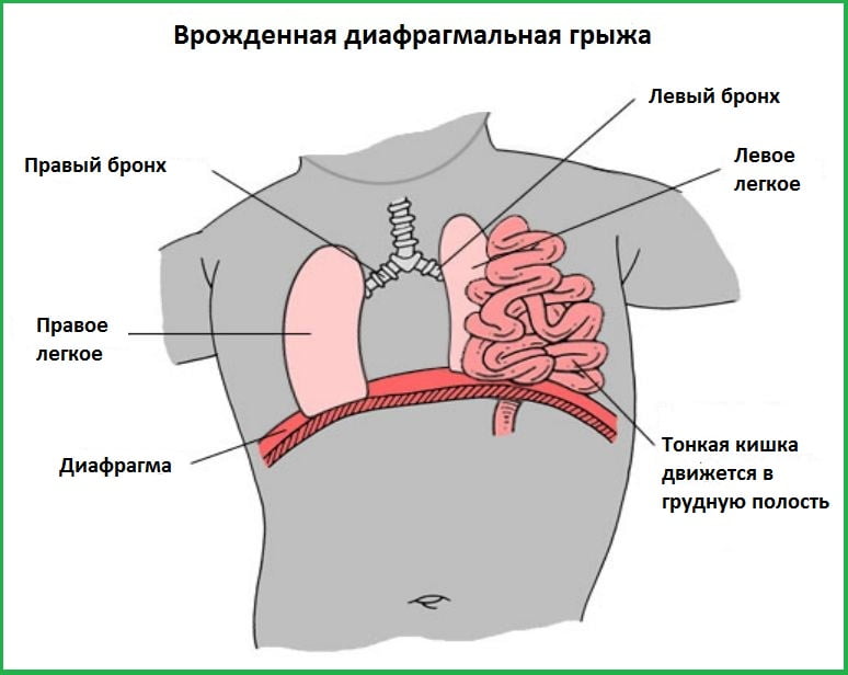 Тонкая кишка движется в грудную полость
