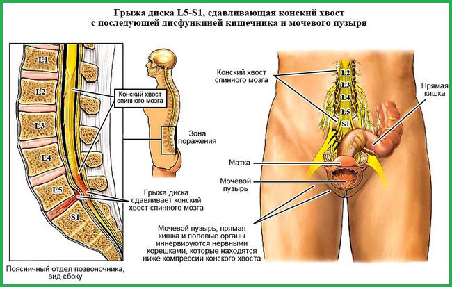 Рисунок показывает синдром конского хвоста.