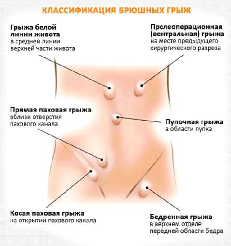 Классификация грыж на животе