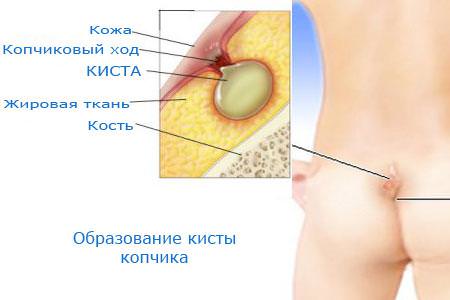 Схематичный рисунок про кисту копчика