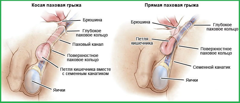 косая паховая