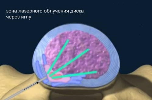 Удаление межпозвонковой грыжи лазером.
