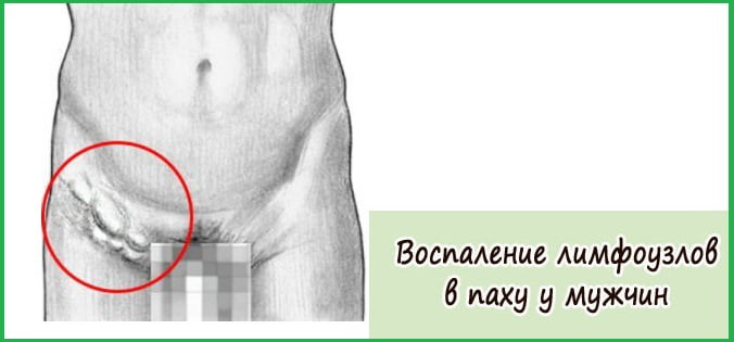 Воспаление лимфоузлов в паху у мужчины.