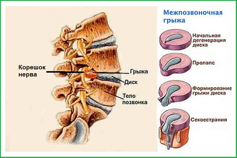 Этапы развития межпозвонковой грыжи.