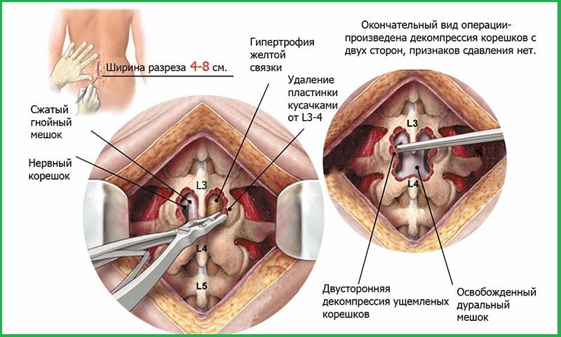 Рисунок описывает как делается операция. по удалению грыжи позвоночника поясничного отдела